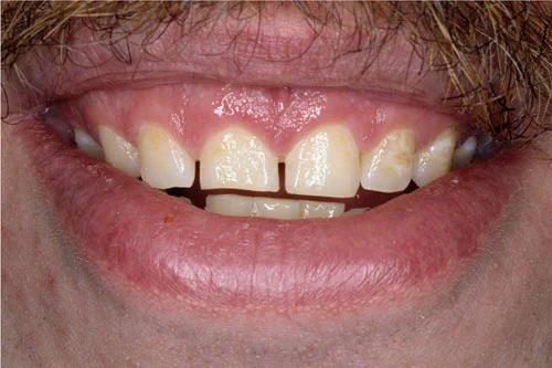 gummy smile before porcelain veneers and gum lift