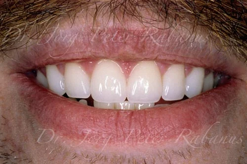 gummy smile after porcelain veneers and gum lift