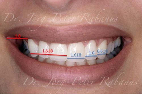 Teeth with Golden Proportions after Smile Design