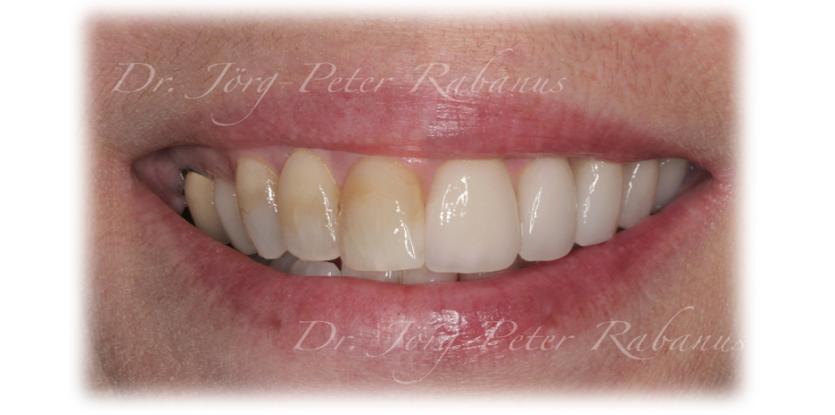 dental enamel compared to porcelain