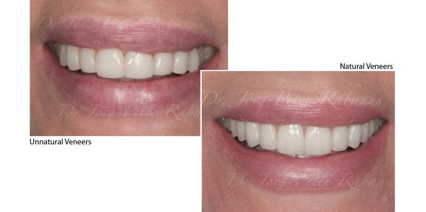 porcelain veneers look natural