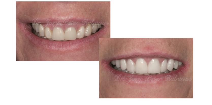 Porcelain Veneers, Smile Design, Gum Lift